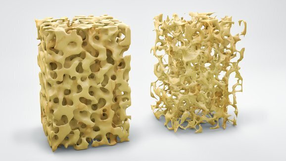 Osteoporose: Implantes de magnésio que dissolvem podem promover a formação óssea