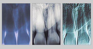 Estética y blanqueamiento dental en la era digital  (Capítulo 8)