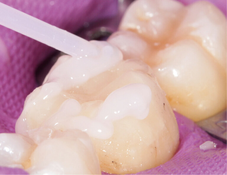 Fig. 13: Applying Liquid Strip to prevent the formation of an inhibition layer