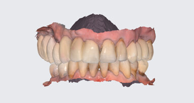 Guided implant placement and restoration: A comprehensive approach