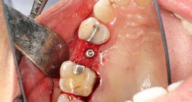 Синтетична мембрана може да ускори оздравяването при имплантиране