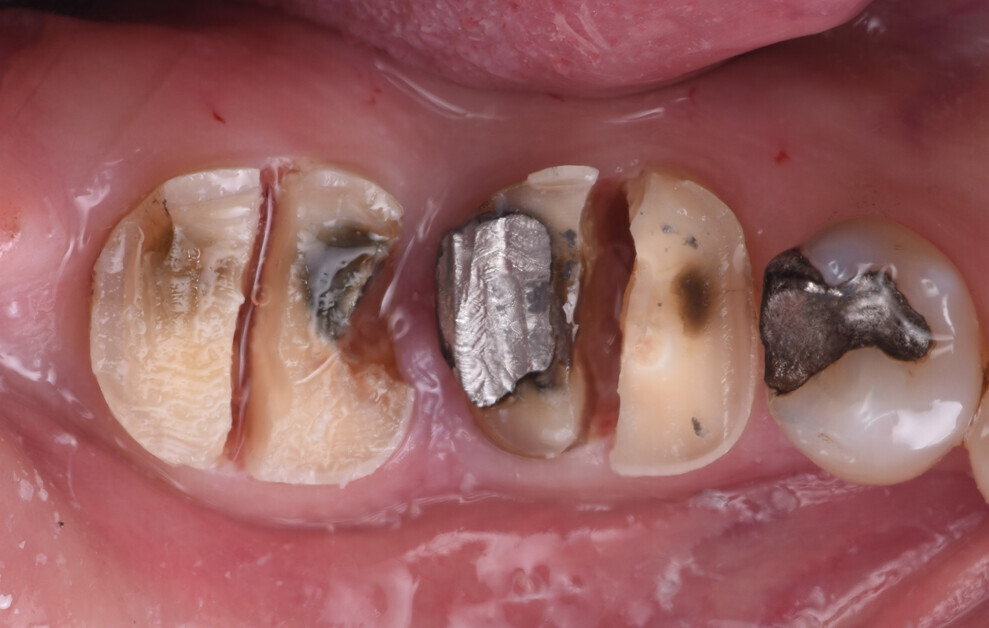 Fig. 7: Existing roots sectioned to allow atraumatic extraction.