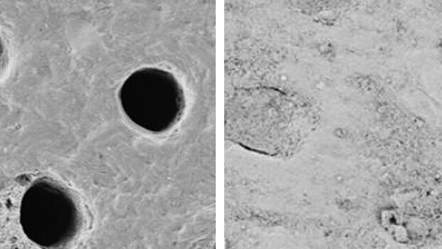 Tooth wear and new technology to manage dentin hypersensitivity