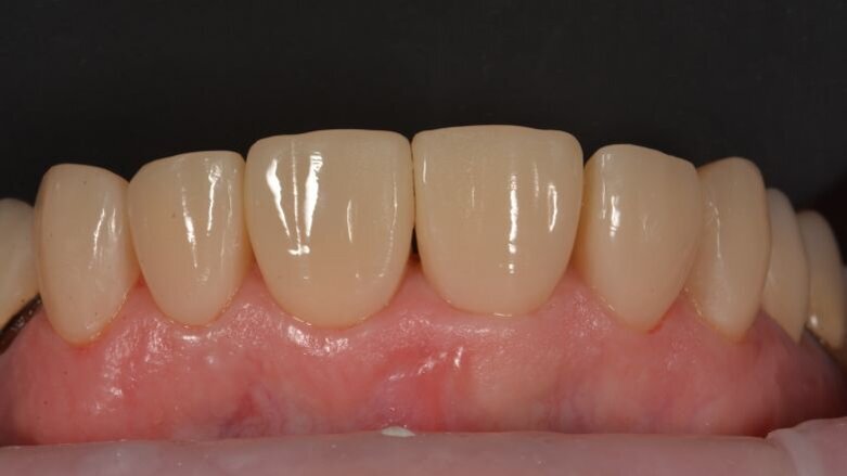 Vereenvoudigd universeel composiet voor esthetisch herstel van een zwaar gerestaureerd bovenfront