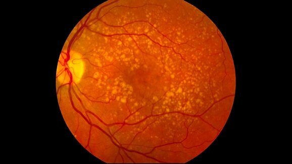 Учени откриват възможна връзка между слепотата и загубата на зъби при мъже