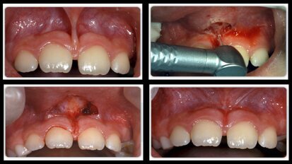 Las matronas no pueden realizar frenectomías   