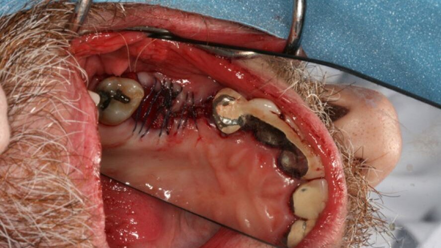 Les propres cellules souches du patient récoltées et transplantées dans sa mâchoire.