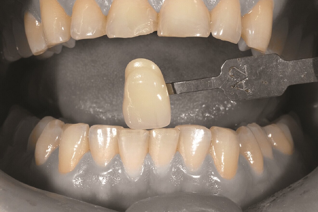 Fig. 4: Shade taking prior to restoration.