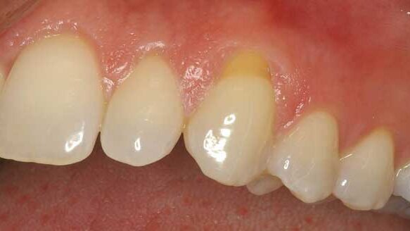 Barriers of success: Cosmetic periodontal surgery (Part 4B)