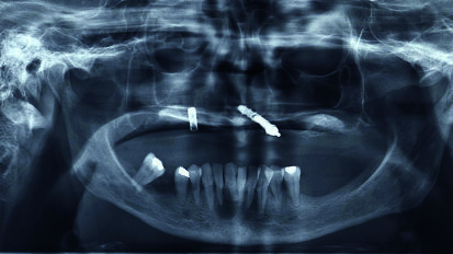 Estetica e funzione: approccio moderno alla riabilitazione del paziente totalmente edentulo