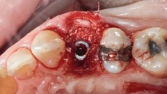 Studio Carosi-Lorenzi: nuove evidenze sulla stabilità degli impianti TLX Straumann nel primo anno di guarigione