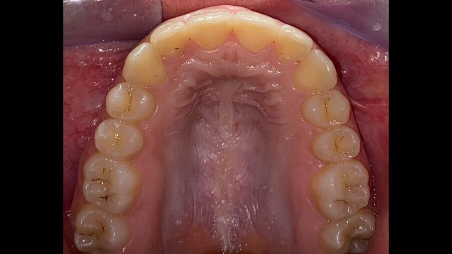 Fig. 21_Occlusale superiore post-trattamento.