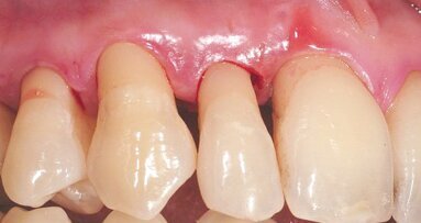 Periodontal decontamination in microsurgery