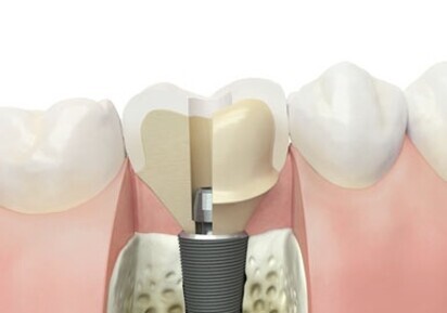 Astra Tech pilier Atlantis™ transvissé