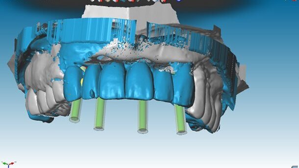 Immediate Smile strategy dans les secteurs esthétiques - Optimisation des technologies numériques au cabinet et au laboratoire au service de la mise en charge instantanée