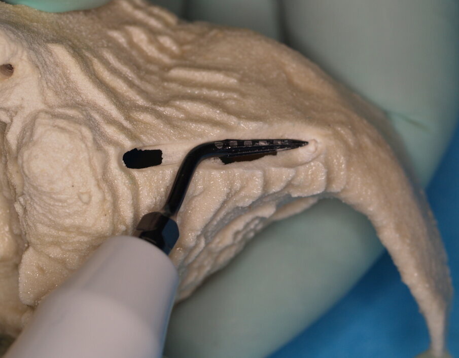 Figg. 9, 10 - Con lo stesso inserto a punta si lavora sulla corticale dello zigomo cercando di proseguire nella preparazione precedente.