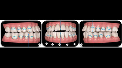 Allineatori trasparenti in tecnica Invisalign, Surgery First in caso di recidiva di iperplasia condilare