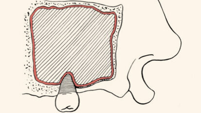Colocación de una prótesis híbrida maxilar para  la rehabilitación fija del edéntulo con reabsorción severa