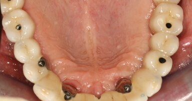 Guides chirurgicaux en implantologie : indications et limites