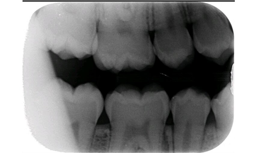 Afbeelding 2a. Bitewings van de blijvende dentitie. 