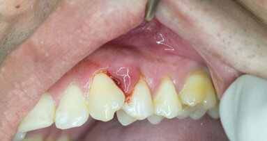 La parodontite pourrait doubler les risques de déclin cognitif, selon une étude