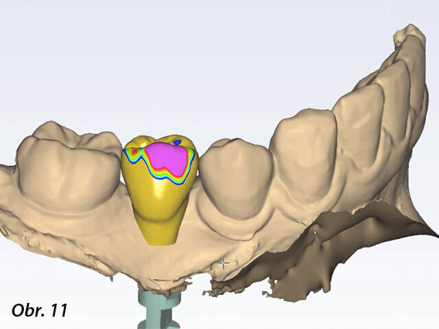 Návrh definitivní náhrady v softwaru Planmeca PlanCAD Premium.