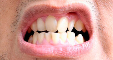 La malocclusione associata a problemi posturali e di equilibrio