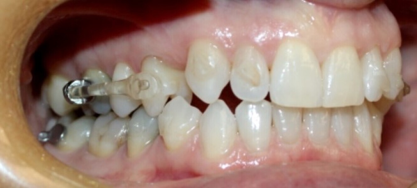 Fig. 19a: After six months of the Carriere Motion appliance and aligners. (a) Lateral view. (b) Occlusal view.