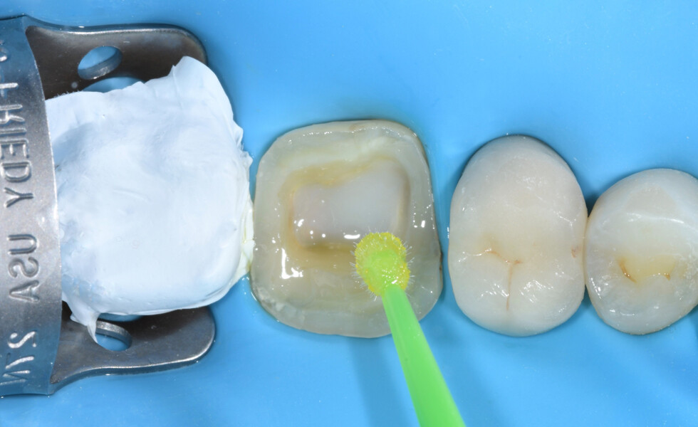 Fig. 10b:  Application of a universal adhesive.