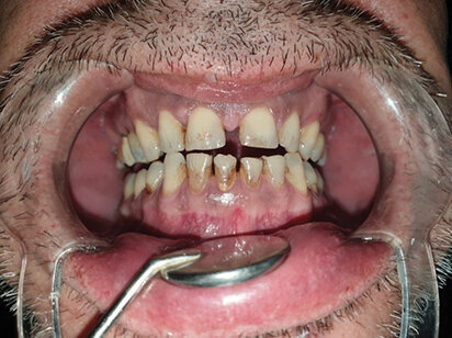 Sl. 1.0: Pacijent A, pušač pri prijemu