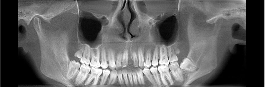 Ryc. 13_Kanał nerwu przysiecznego.