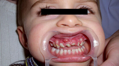 Narkose-Sparkurs: Kinderzahnärzte und Anästhesisten schlagen Alarm Narkose-Sparkurs: Kinderzahnärzte und Anästhesisten schlagen Alarm