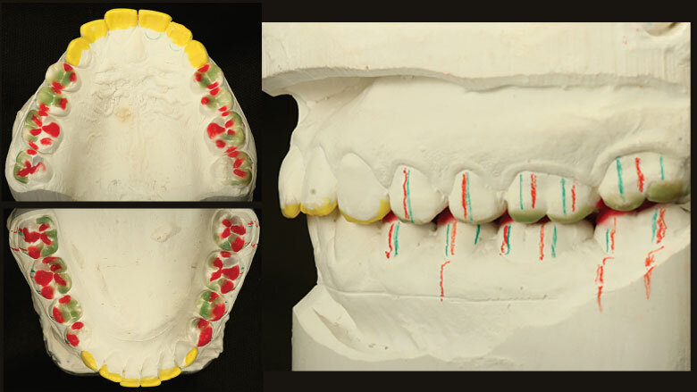 Figure 3: Diagnostic wax-up