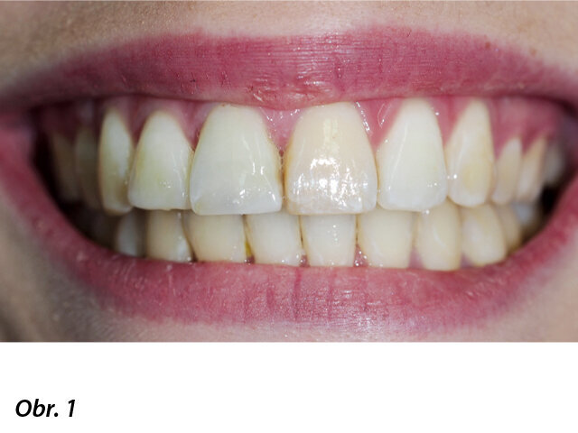 Žlutavá diskolorace horního levého středního řezáku