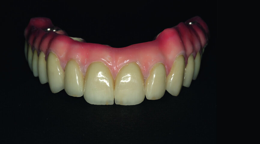Fig. 24: Final restoration—frontal view.