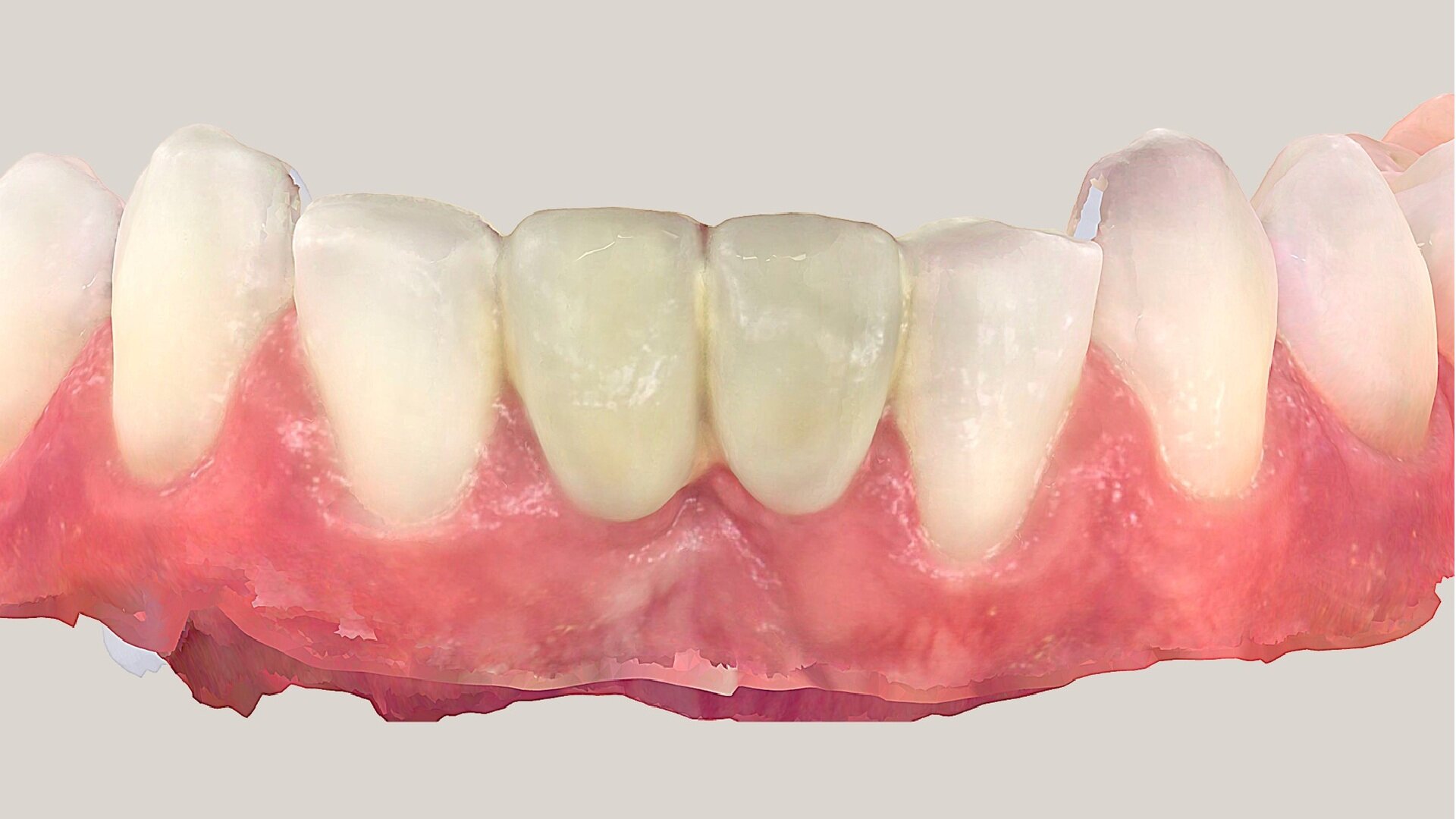 Optimising design and shade—replacement of a resin-bonded bridge for aesthetic reasons