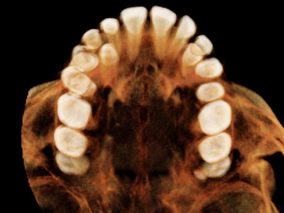 Fig. 22_Dettaglio del percorso di eruzione dei canini.