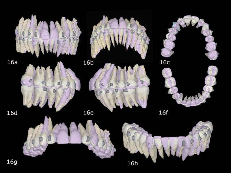 Figs. 16a–h: Pretreatment situation (purple) and expected post-treatment situation (white) in FAS OcclusalDesign.