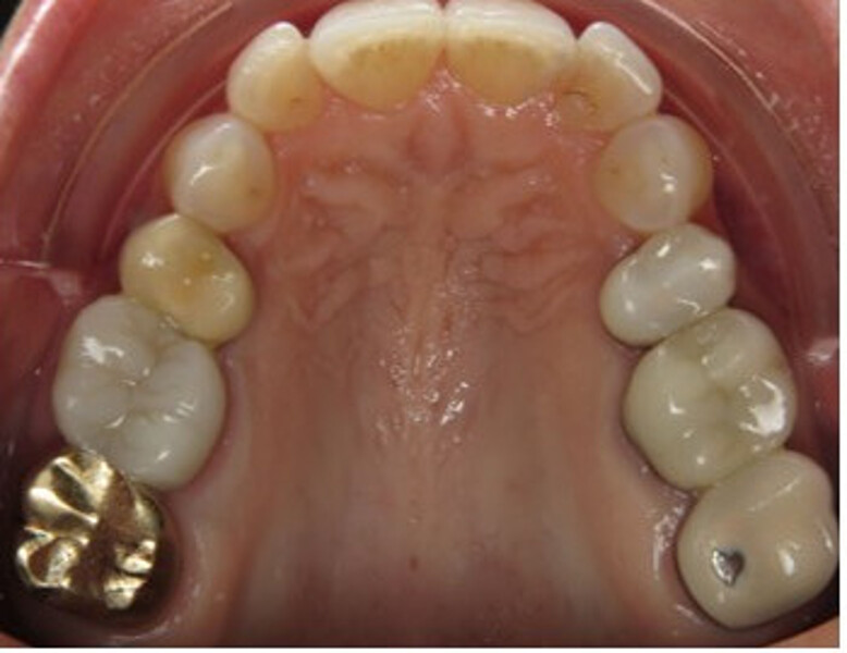 Figs. 1a–e: Pretreatment photographs showing the patient’s initial malocclusion. 