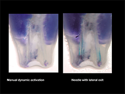 Slika 2b: Sleiman-Iandolo test. Rezultat uklanjanja boje manuelnom dinamičkom aktivacijom (levo) i iglom sa lateralnim otvorom. Manuelna dinamička aktivacija Igla sa lateralnim otvorom
