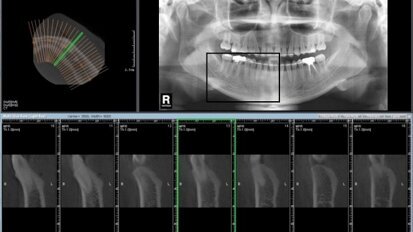 Η παραδοσιακή απεικόνιση δε θα εξαφανιστεί με την εφαρμογή της Υπολογιστικής Τομογραφίας Κωνικής Δέσμης-CBCT