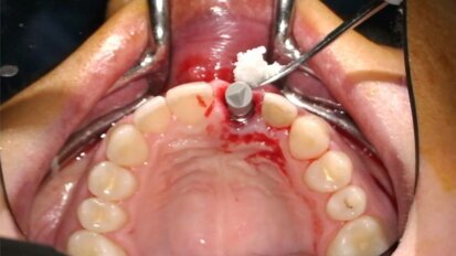 Gestione dei tessuti molli peri-implantari in pazienti con sorriso gengivale