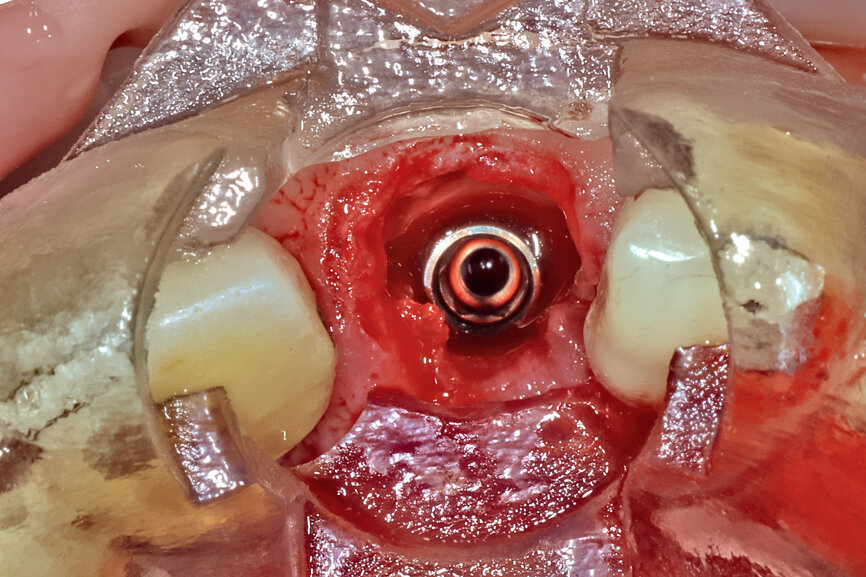 Fig. 24b: Depth control and rotational positioning were accurately
confirmed with the notch indicator on the template corresponding with the insertion tool (a). The occlusal view illustrated that the anti-rotational internal
conical–hexagonal connection was positioned towards the facial aspect (b).