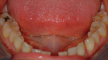 Estetica del sorriso: approccio interdisciplinare ortodonzia-implantologia – seconda parte