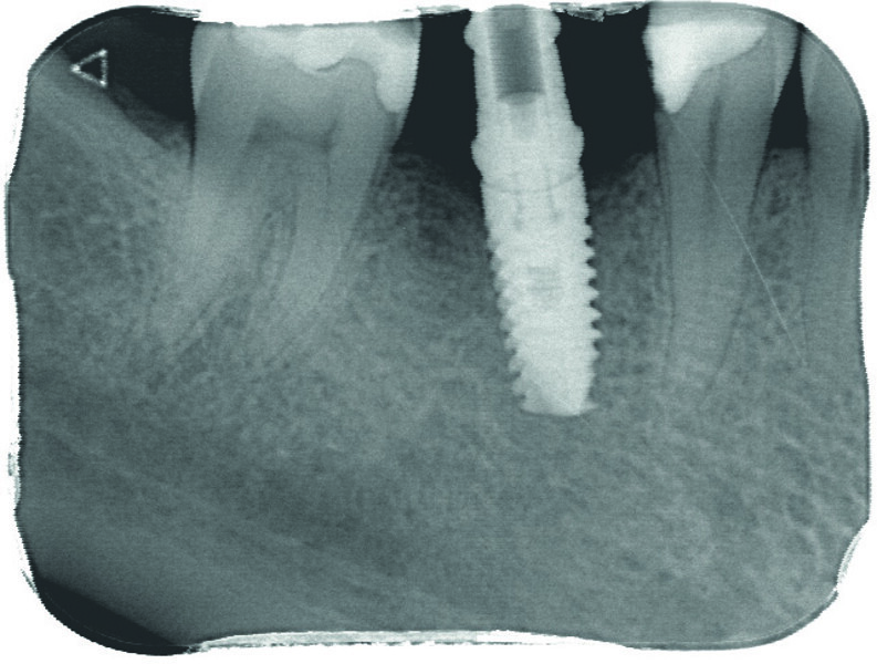 Fig. 18 : Contrôle radiographique de la bonne assise du transfert. 