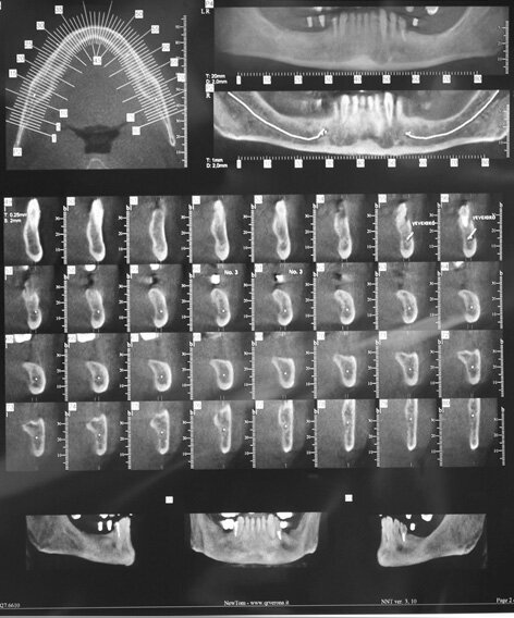 Fig. 10: Implant position planning on the CT image  