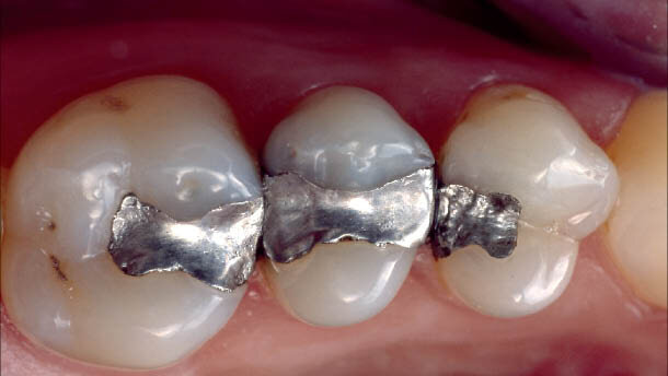 Cementování nepřímých estetických prací