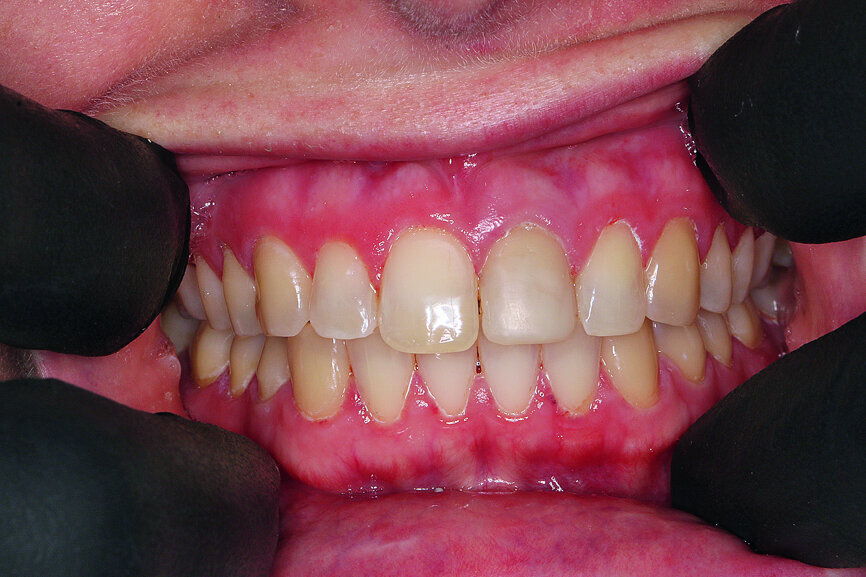 Fig. 2: Initial situation: tooth #21 exhibited marginal redness of the gingiva that bled when probed.