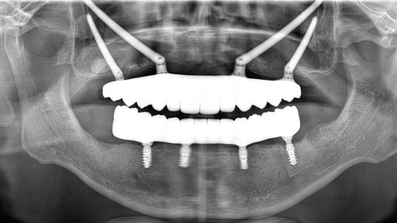 Fig. 19: Panoramic radiograph showing the definitive prostheses supported by the four zygomatic implants and four conventional implants.