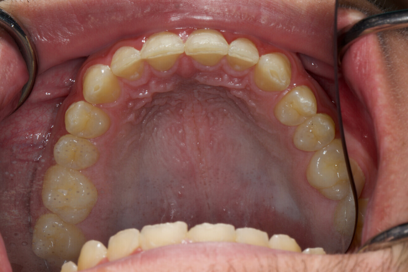 Fig. 3: Intra-oral photograph of the maxillary arch.